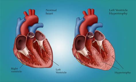 left ventricular hypertrophy now present